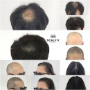 스칼프K 이미지