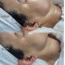 대동씨코아경로당 | 필러 대신 이거? 마산 유일 목주름 관리 후기
