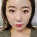 O-1 | 강남피부과 슈링크유니버스 300샷 혜자 맛집 1회차 후기 효과O