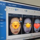 강남피부과 눈밑꺼짐 콜라겐주사 미희주사 후기