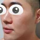 메디필피부과의원 | 남자 프락셀 턱 보톡스 후기 - (하편)