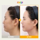 프레쉬홍닥터의원 | 처진얼굴 리프팅 안면거상 미니거상 효과 (신사역 프레쉬홍닥터의원 - 구. 프레쉬성형외과)