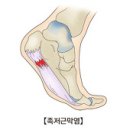 Plantar Fasciitis "발바닥 통증" 이미지