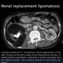 Renal replacement lipomatosis 이미지