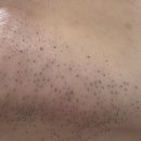 베일러의원 | [신사] 강남 피부과 베일러의원 인중/턱 레이저제모 후기 (1회차)