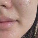 주식회사 본메디케어 | 기미 잡티 관리 케어 앰플보단 메디폴트 센피큘 크림으로