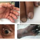 아성반점 - 남동구 | 감염성 심내막염 (Infective Endocarditis, IE)