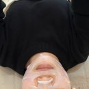 제일어린이집 | 부산해운대 출산후 이중턱관리, 슈링크대신 온다리프팅 2주지난 후기