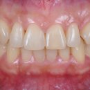 공도오케이치과의원 | [의왕 치과/오전동치과] 앞니 벌어짐(다이아스테마) 레진 변색 및 파절 재치료 후기