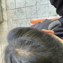 새로나약국 | 먹는 탈모 약(피나스테리드) 와 바르는 미녹시딜 병행 6개월 후기, 부작용, 현재 상태