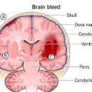 뇌출혈 초기 증세 구토 코피 포함 및 뇌출혈 골든타임 이미지