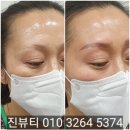 용인척의원 | 수원 잘못된 눈썹 교정 잘하는곳 (+후기)