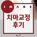 설측교정부터 클리피씨까지, 치아교정 고민이라면 이 후기부터 보세요