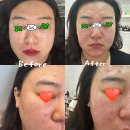 연화세천 | [다사·세천에스테틱] 재방문한 오피뉴에스테틱 여드름케어 찐 후기