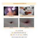 만성담낭염수술후기. 쓸개 제거는 튼튼병원이 잘한다는 말을 듣고 왔는데 잘한거 같다고 생각되었습니다. 이미지