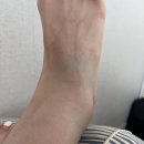 서재곤링커병원 복사골 골절 후기