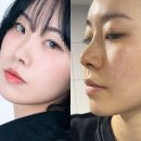 (주)신성에너지 | 강남역 리프팅 전문 코프팅 과 V프팅 전후 실제후기