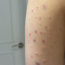 창원어반브릭스 원브로우 바디지방분해주사 라인톡스 테라노바 팔 시술관리 찐 후기