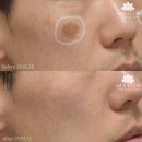 대구흑자제거 어떤 치료법이 효과적일까 이미지