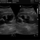 ureter stone with hydronephrosis 이미지