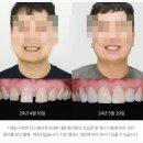 프레스치과의원 | 비니어치아 시술 및 비니어가격에 대한 현실 조언 A to Z