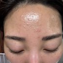헬로테라피 | 청주 비하동 라에브에스테틱 | 여드름 압출 후 리셋+물방울 테라피 후기