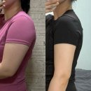 팔복장 | 팔 뒷볼록 빼는 법 -6cm 인천팔뚝주사 3개월 솔직후기