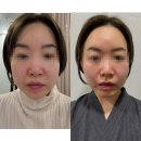 신사동-6 | 신사동피부과 온다리프팅 + 쥬베룩 볼륨 팔자주름 효과 리얼후기