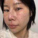 예쁨주의쁨의원 | 건대피부과/필로드 나비존 후기 “건대예쁨주의쁨의원”