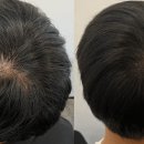 리아앤스칼프 | 대구 두피문신 잘하는곳! 리아앤스칼프 정수리 탈모커버 대만족 후기ㅣ할인중ㅣ대구두피커버, 대구탈모커버