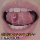후 | 혀 밑 점액낭종/유두종 재발 후 수술 후기