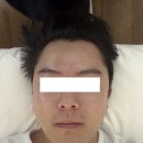 근만 | 이대신촌역 윤곽관리 마이온스킨, 얼굴이 가벼워졌어요!