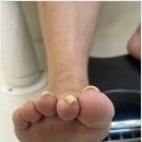 718 | 대전 복수동 내성발톱 편안한 전문관리 네일의아침 내성발톱 무좀 발각질 네일 문제성발