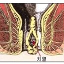 - 항문열창의 침뜸처방(809) 이미지