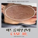 오션스파 | 광주여드름피부관리 사례 30.