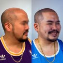 모델헤어라인 | 두피타투 가격 두피문신 헤어라인 후기