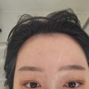 인천 헤어라인 교정 어디서? 스테이무아｜SMP 시술로 자신감 되찾은 후기💬