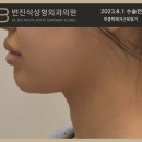신경 쓰이는 이중턱살! 턱살이 찌는 이유와 턱살을 제거하는 방법