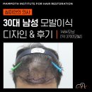 압구정맘모스헤어라인의원 | 압구정 맘모스헤어라인의원, 30대 남자, Devroye 트럼펫 팁 비절개 채취