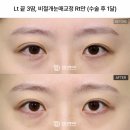 두줄따기후기, 실패 없는 라인 낮추기를 위한 핵심 체크포인트