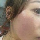 뷰티빛담 - 연제구 | 대전피부관리 피부결 개선 원한다면? 빛담 바이오필링 솔직후기 대전여드름압출