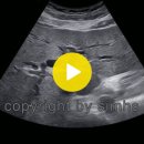 Intrahepatic Duct Dilatation Caused by Extrahepatic Billiary Obstruction 이미지