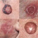 기저세포 암종 (Basal cell carcinoma) 이미지