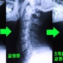 바른자세교정 네이버블로그