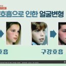 아침 입냄새 원인 구강호흡 or 편도결석(제거법) 이미지