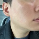 압구정 피부과 엑소좀 스킨 부스터 엑소라인 라파인 후기