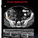 Acute Appendicitis 이미지