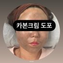 투유피부관리 | 광주기미관리 미백토닝 쌍촌동 투유뷰티 피부관리 후기