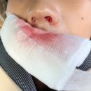 삼성온아이비인후과의원 | 삼성드림이비인후과 종로점 비중격만곡증&amp;비염 수술 후기 1편 / 25.12.04 수술