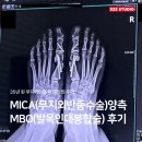 건우 크린 | 6탄) 무지외반증 MICA와 MBO 콜라보, 드디어 마지막 진료!!!